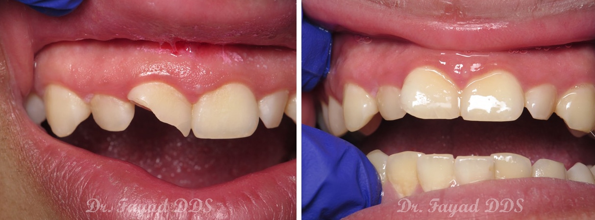 broken front tooth treatment before and after at Lessard Dental