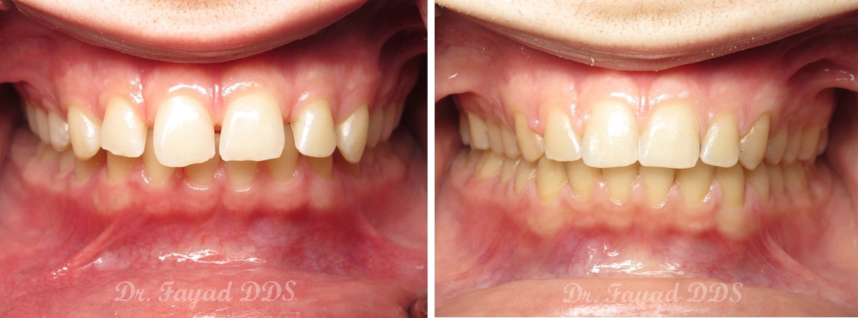 before and after orthodontics spacing treatment at Lessard Dental