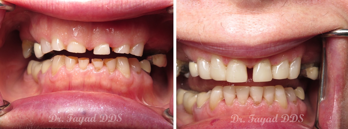 before and after dental reconstruction at Lessard Dental