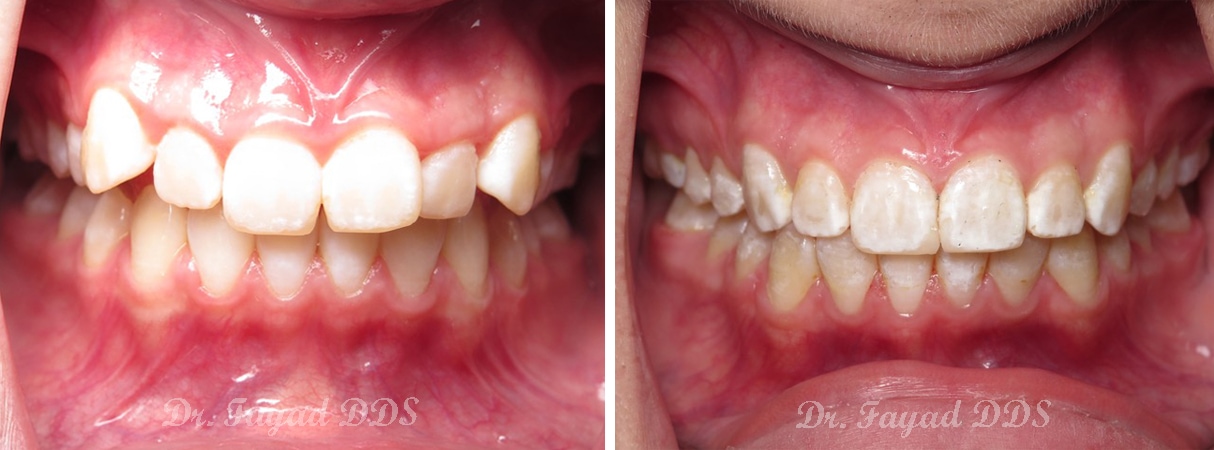 crowding treatment before and after at Lessard Dental