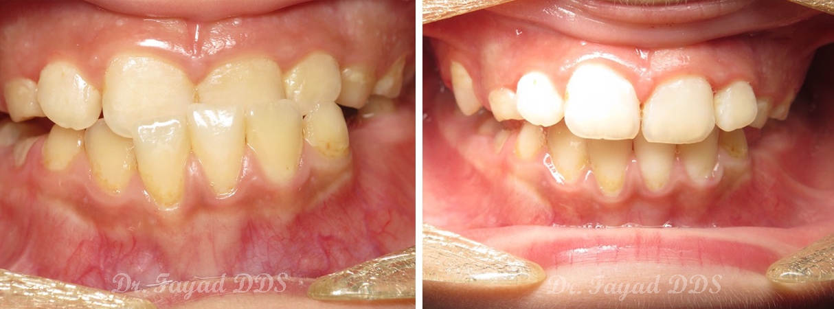 kids cross bite treatment before and after at Lessard Dental