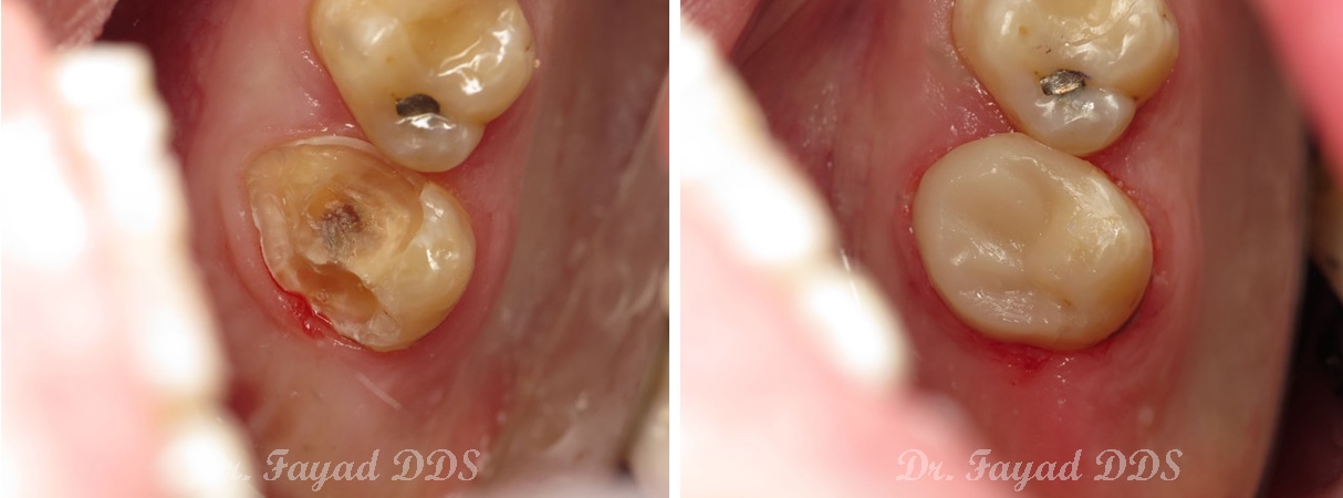 broken teeth treatment before and after at Lessard Dental