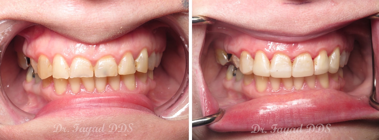 before and after dentures treatment at Lessard Denta;