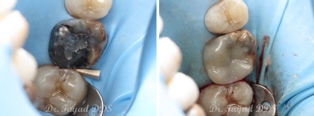 broken amalgam before and after at Lessard Dental