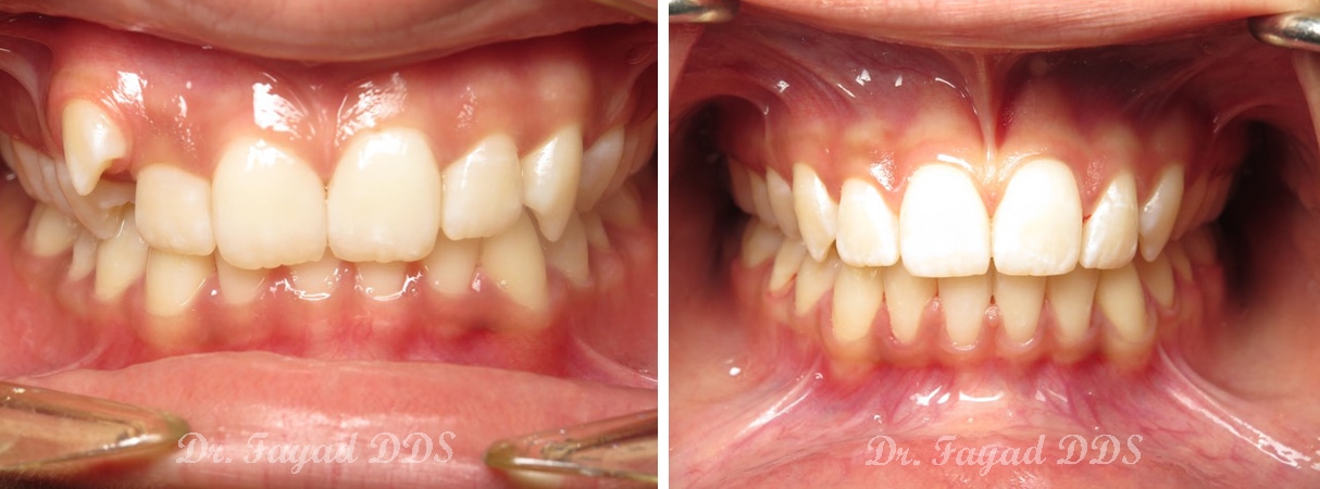 before and after canine ectopic eruption treatment at Lessard Dental