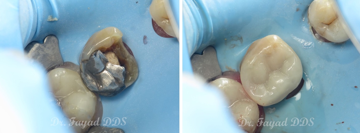 before and after of composite fillings at Lessard Dental