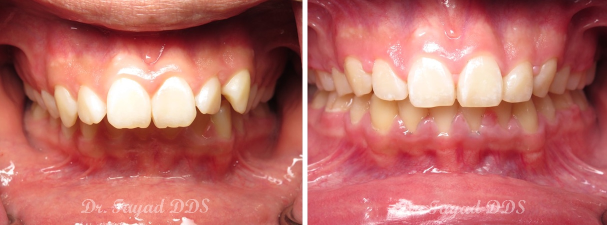 jaw surgery before and after at Lessard Dental