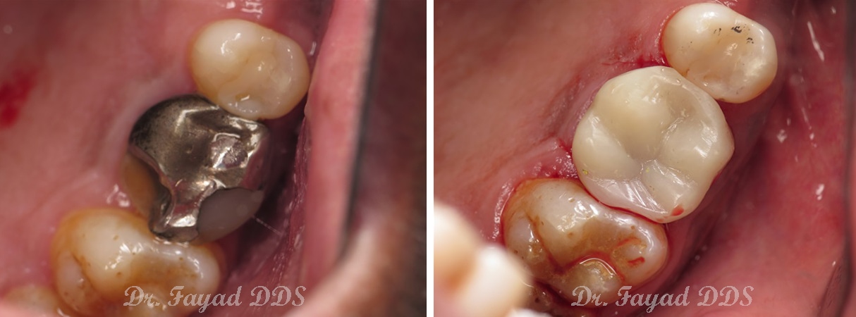 broken large filling before and after at Lessard Dental