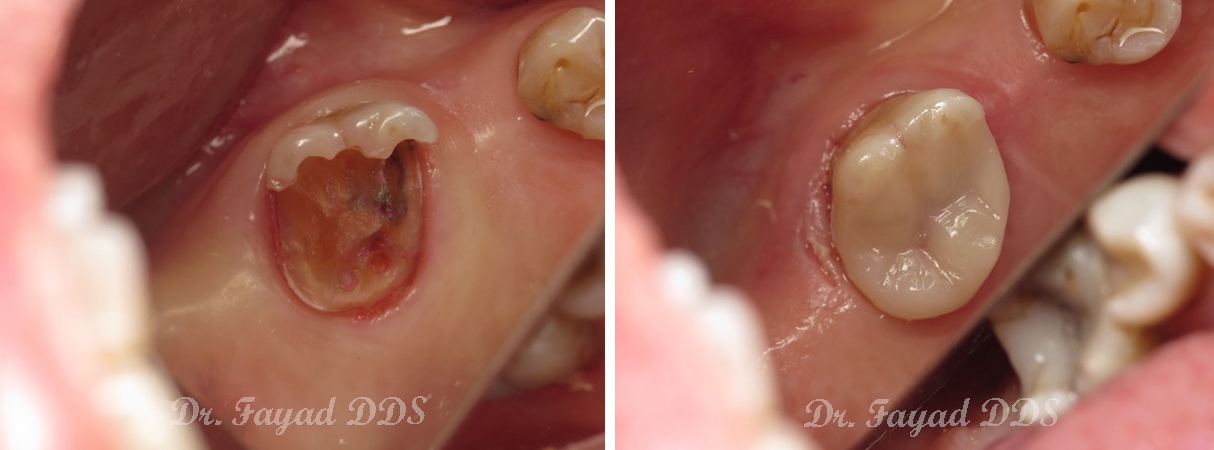 composite fillings before and after at Lessard Dental