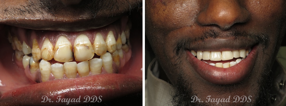 composite bonding treatment before and after at Lessard Dental