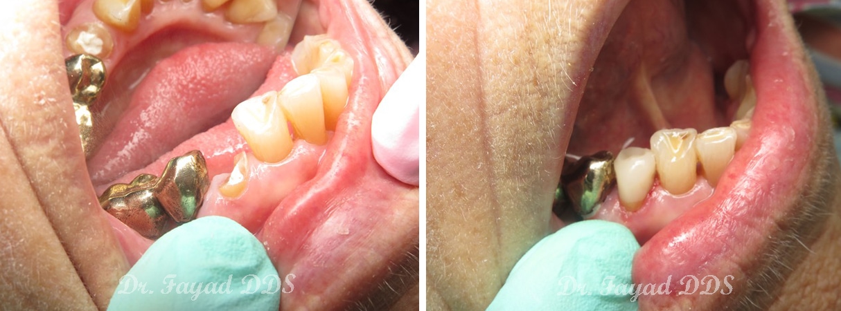 before and after dental implants at Lessard Dental