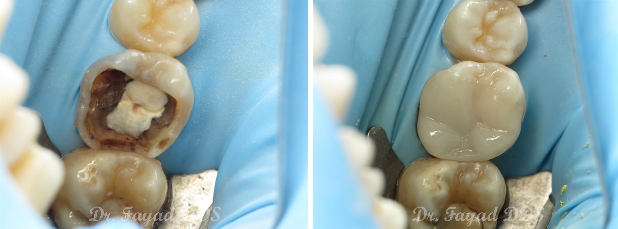dental fillings treatment before and after at Lessard Dental