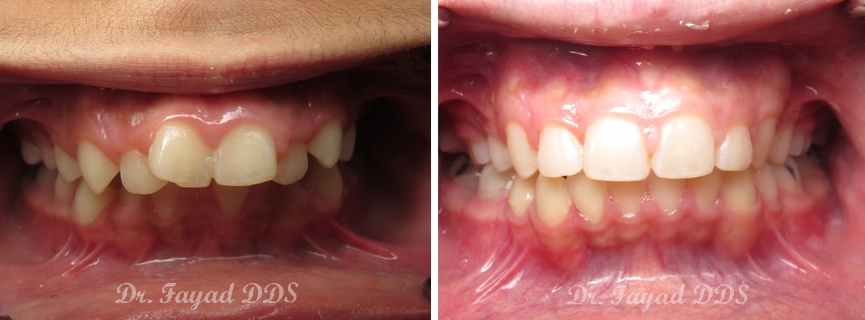 dental crowding treatment before and after at Lessard Dental