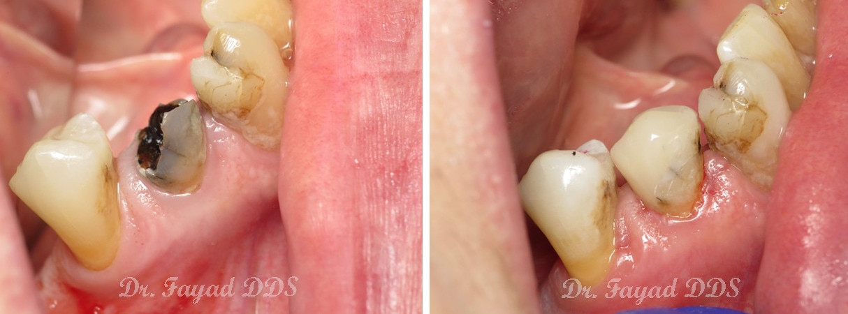 before and after dental amalgam treatment at Lessard Dental