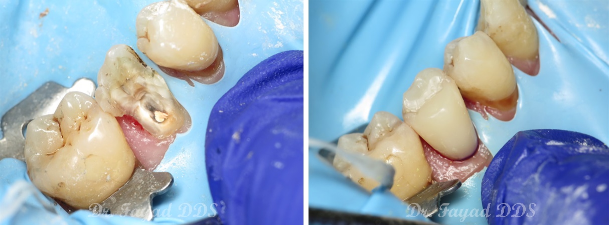 same day treatment before and after at Lessard Dental