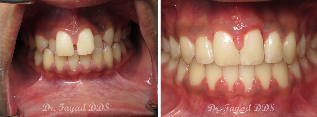crowding and cross bite treatment before and after at Lessard Dental