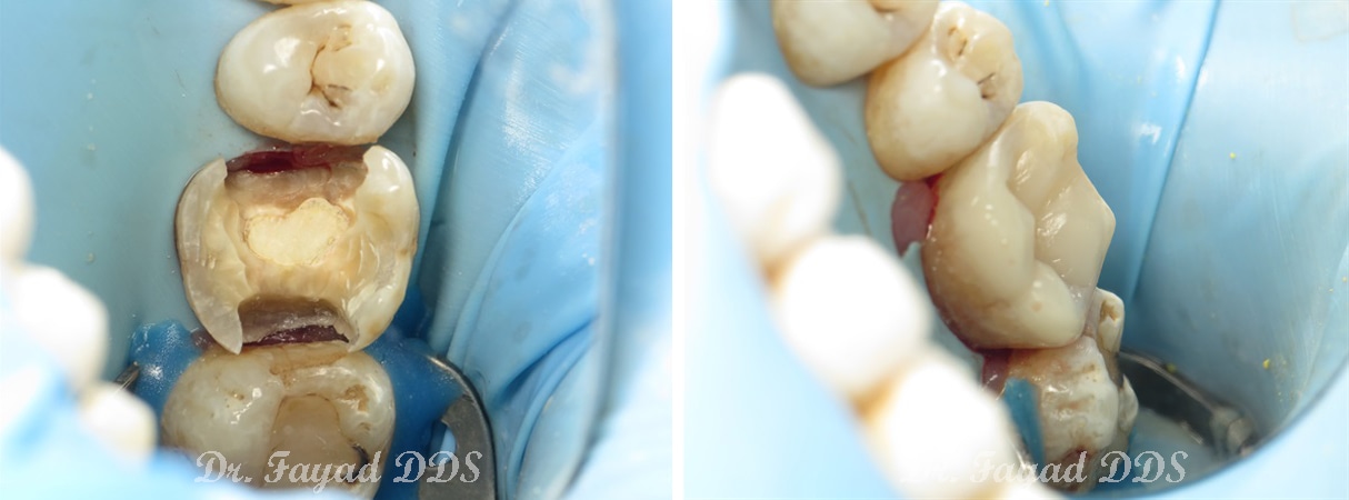 dental emergency before and after at Lessard Dental