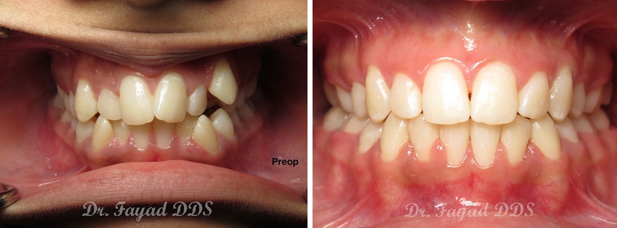 teeth crowding before and after at Lessard Dental