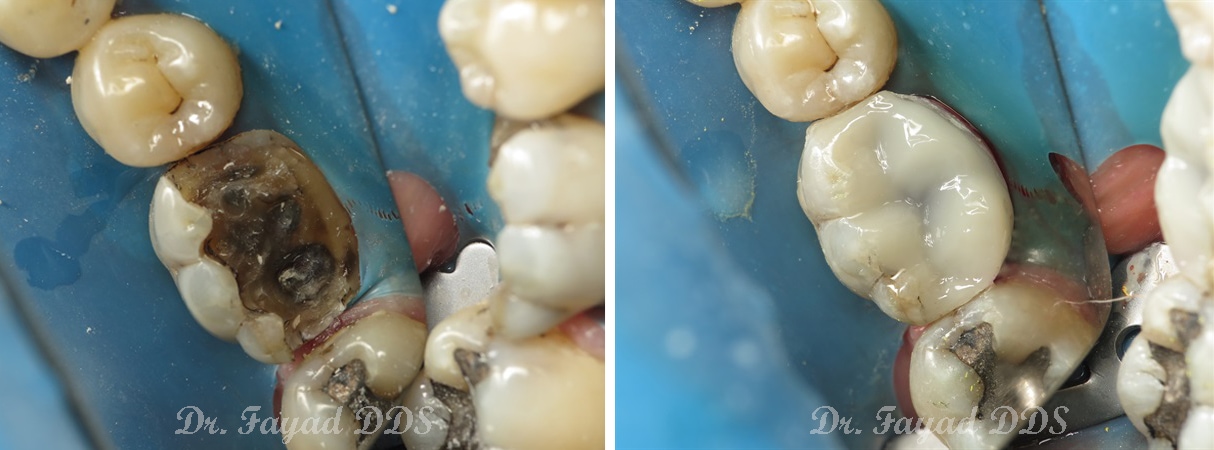 same day treatment before and after Lessard Dental