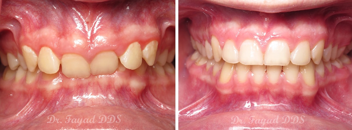 deep bite treatment before and after at Lessard Dental