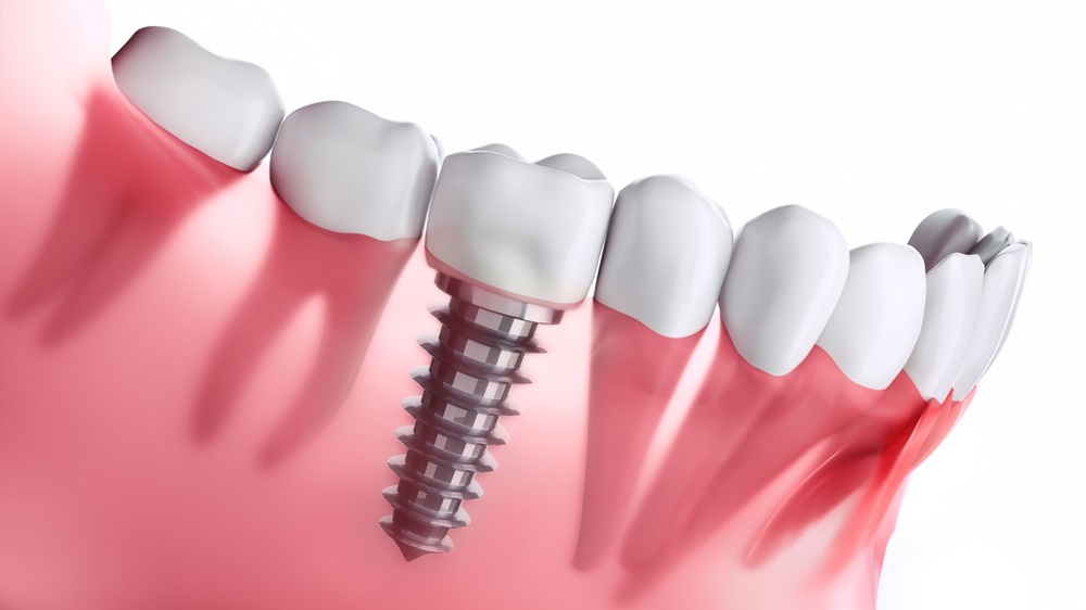 dental implants in West Edmonton